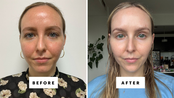 Can You Use Azelaic Acid With Tretinoin? Dermatologists Weigh In.